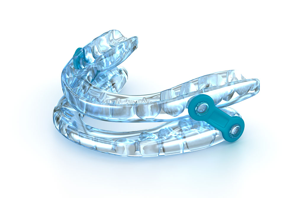 Custom oral appliance for sleep apnea and snoring