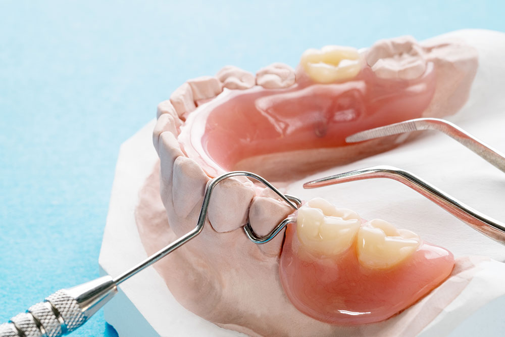 Removable partial denture