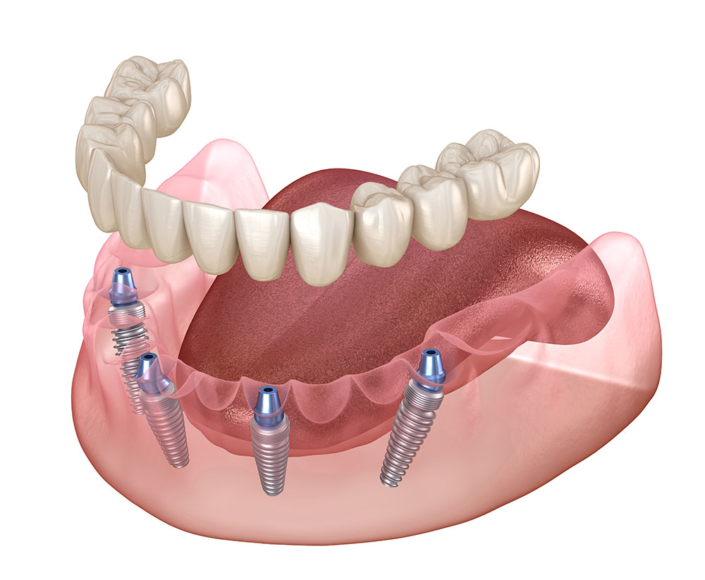 Illustration of an implant-supported lower denture