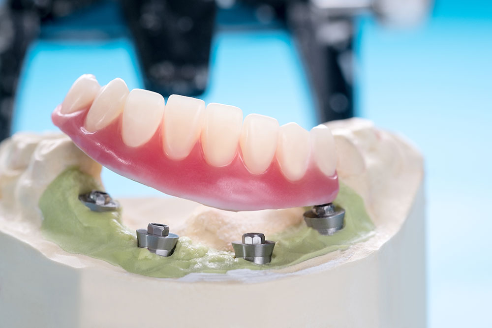 Snap-on overdenture model showing a full arch that clicks onto four dental implants