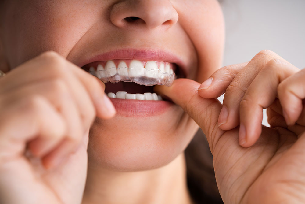 Patient fitting a custom oral appliance