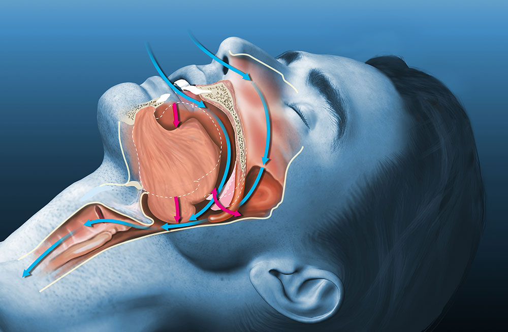 Illustration of a blocked airway during sleep apnea