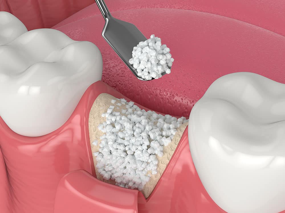 Illustration of bone graft material placed into a tooth socket after extraction