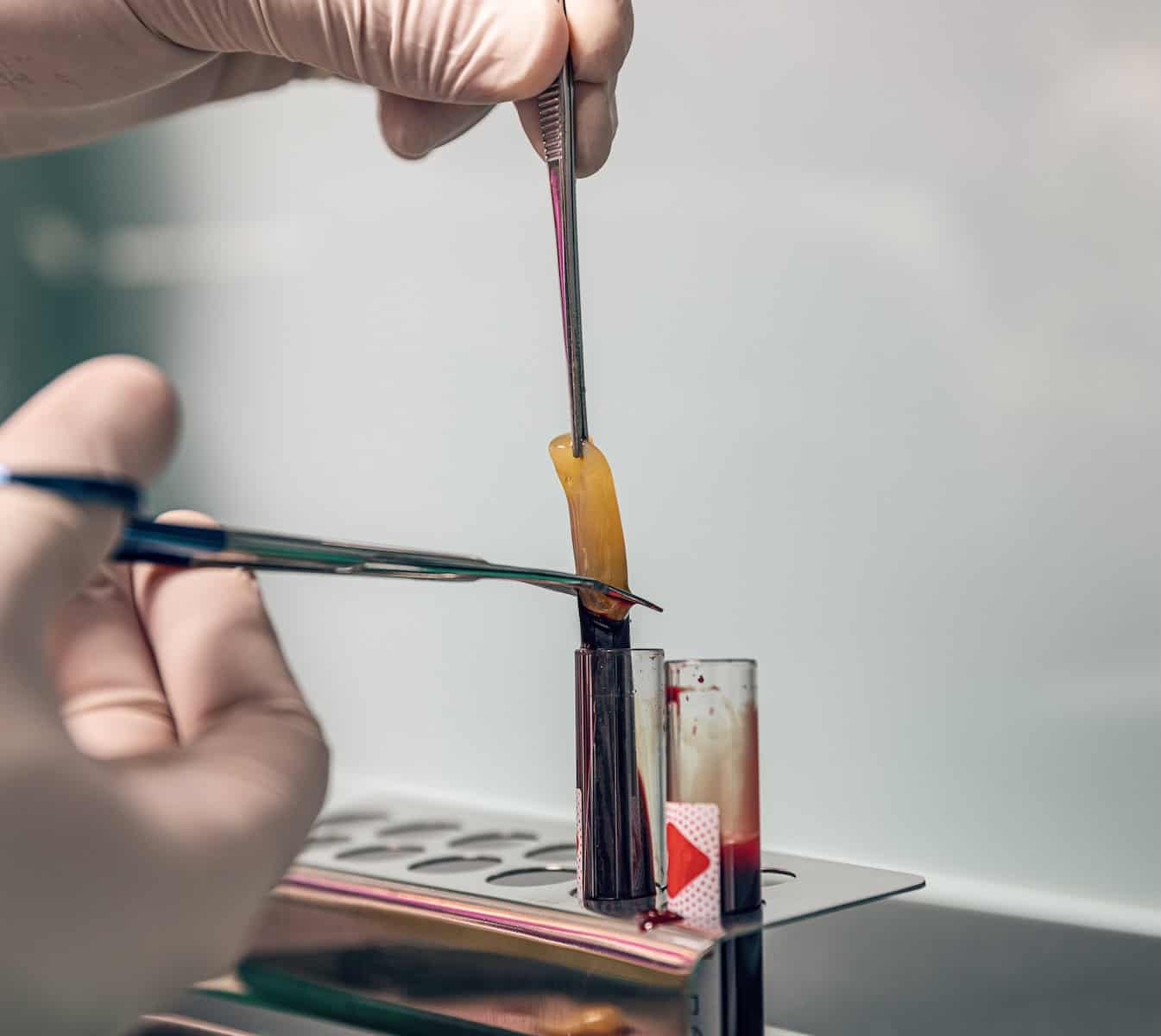 Platelet-rich fibrin membrane prepared from the patient's own blood