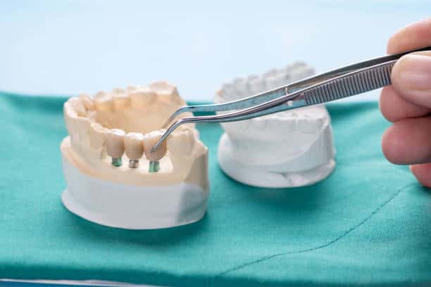 How a Prosthodontist Plans Dental Implants Differently