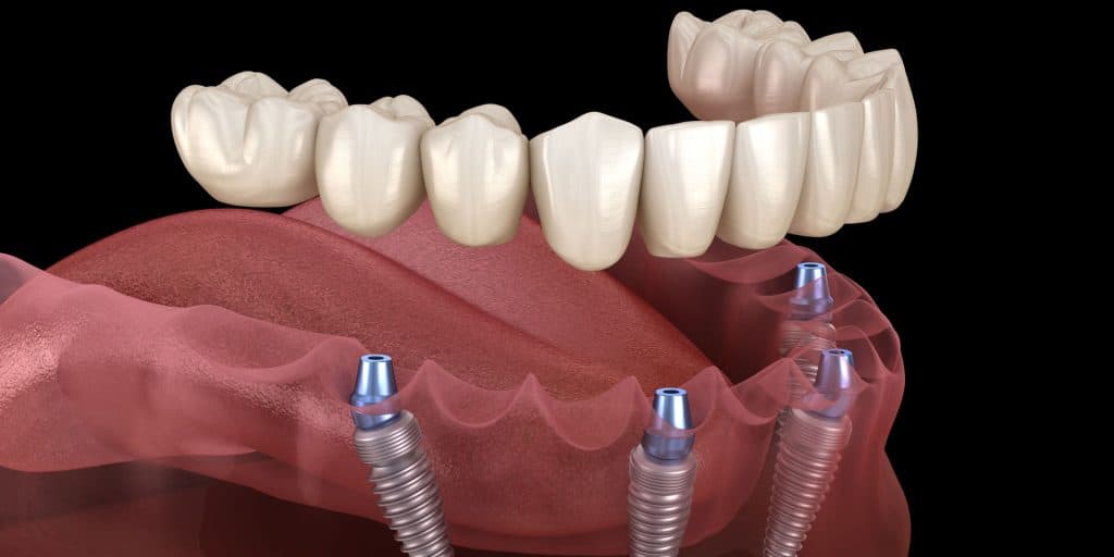 Full-arch fixed bridge supported by four dental implants, the All-on-4 style