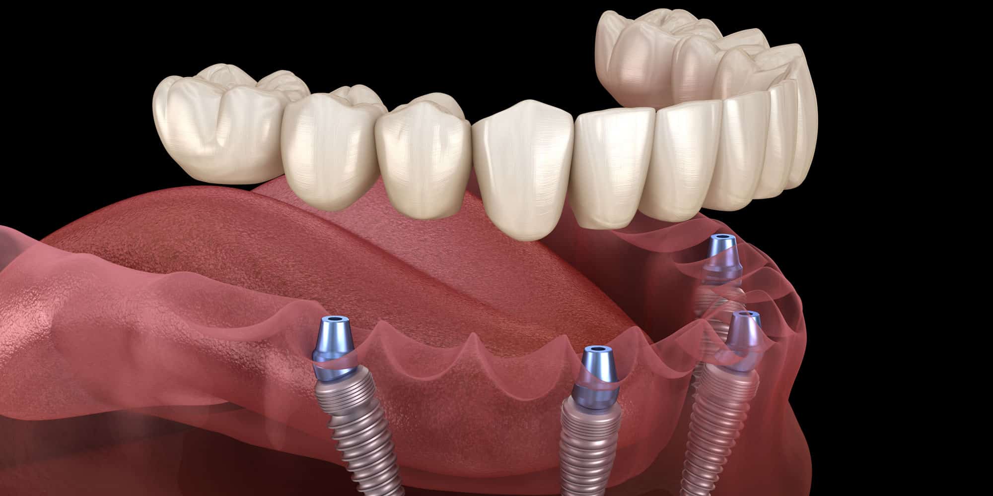 All-on-4 full arch dental implant model showing a fixed bridge anchored on four implants