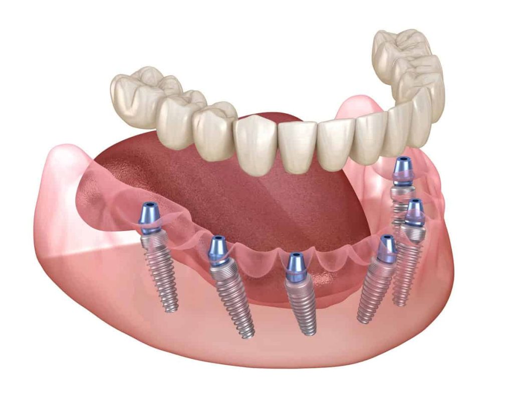 Fixed full-arch dental implant bridge above a lower jaw showing the supporting implants